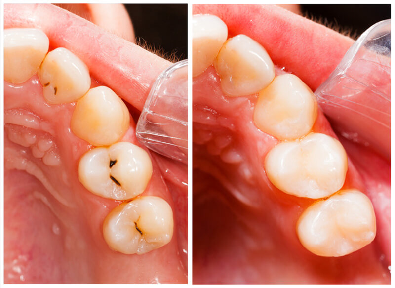 Fillings Park Rapids, MN