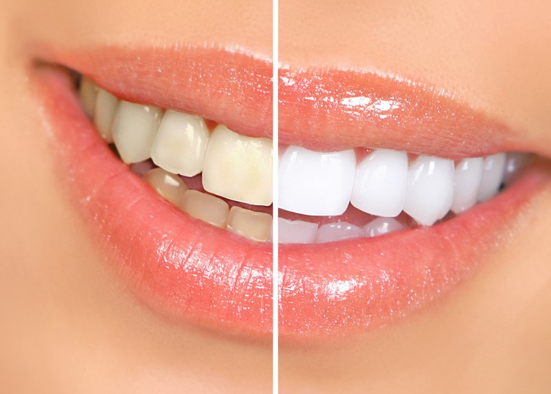 Teeth Whitening Park Rapids, MN